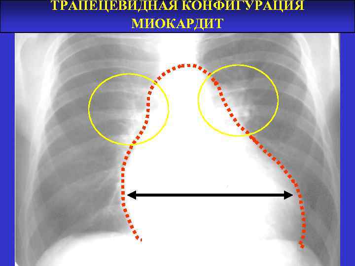 ТРАПЕЦЕВИДНАЯ КОНФИГУРАЦИЯ МИОКАРДИТ 