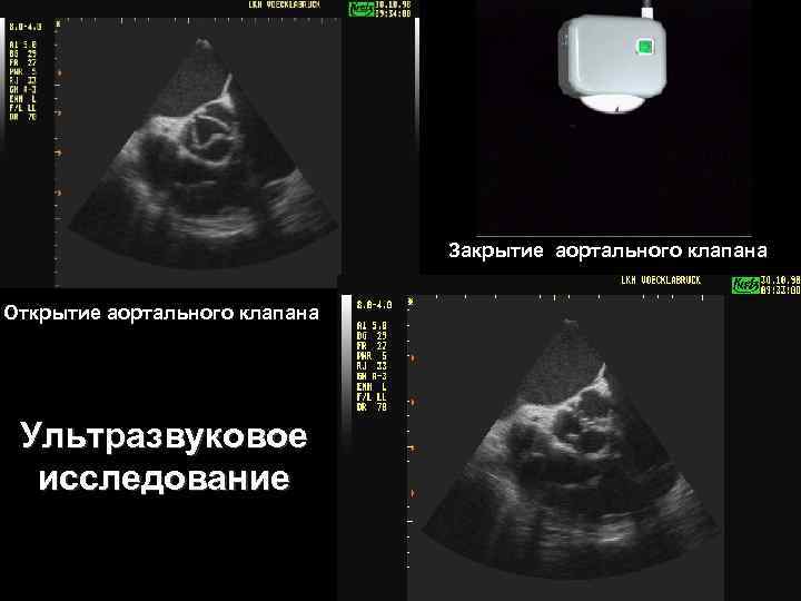 Закрытие аортального клапана Открытие аортального клапана Ультразвуковое исследование 