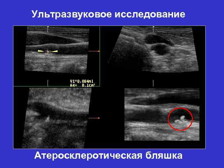 Ультразвуковое исследование Атеросклеротическая бляшка 