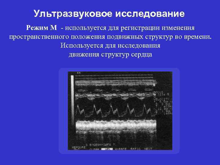Ультразвуковое исследование Режим М - используется для регистрации изменения пространственного положения подвижных структур во