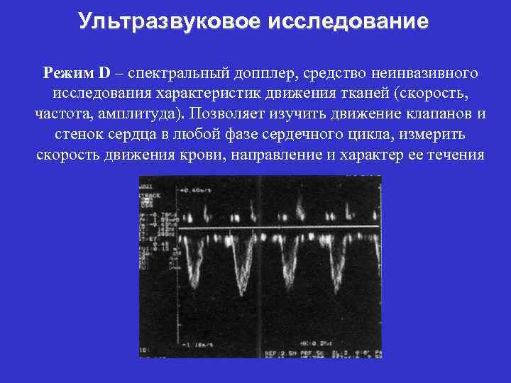Ультразвуковое исследование Режим D – спектральный допплер, средство неинвазивного исследования характеристик движения тканей (скорость,