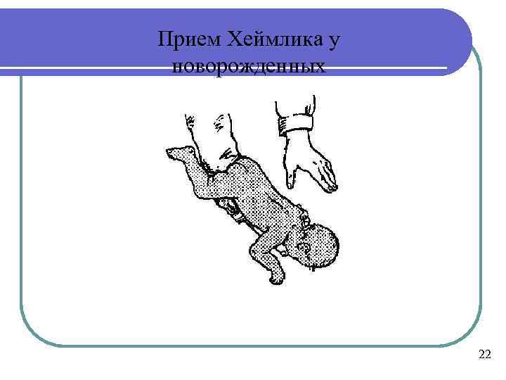 Прием Хеймлика у новорожденных 22 