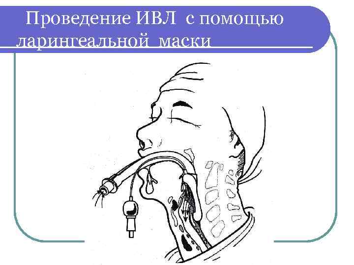 Острая дыхательная недостаточность картинки для презентации