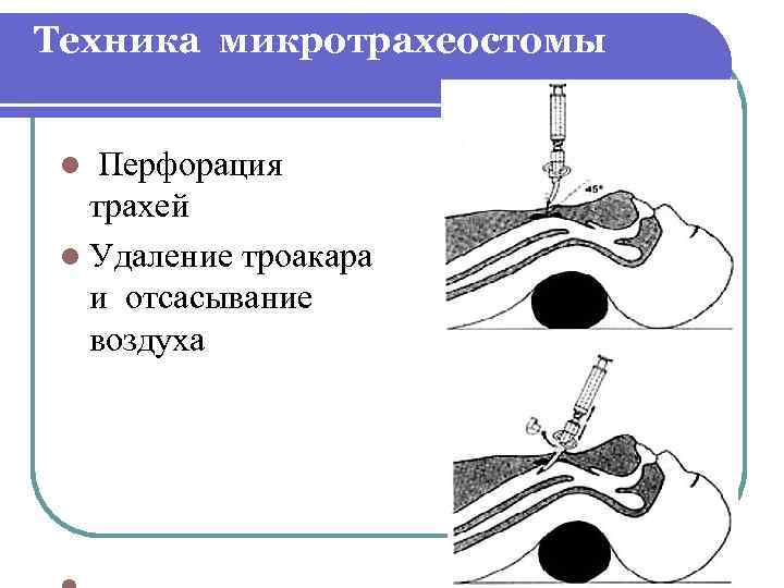 Техника микротрахеостомы Перфорация трахей l Удаление троакара и отсасывание воздуха l 