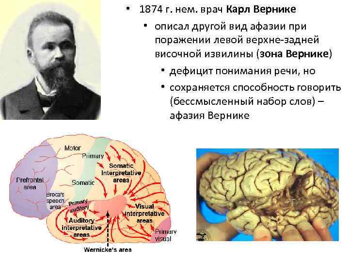  • 1874 г. нем. врач Карл Вернике • описал другой вид афазии при