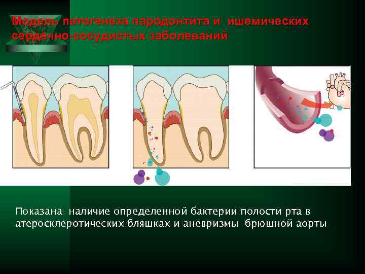 Модель патогенеза пародонтита и ишемических сердечно-сосудистых заболеваний Показана наличие определенной бактерии полости рта в