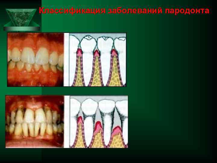 Классификация заболеваний пародонта 