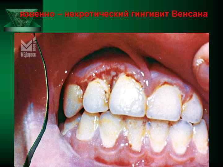 язвенно – некротический гингивит Венсана 