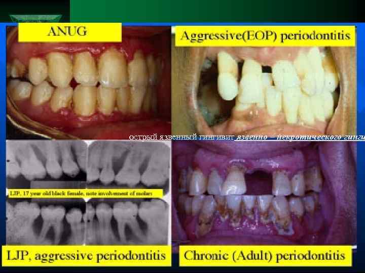острый язвенный гингивит язвенно – некротического гинги 
