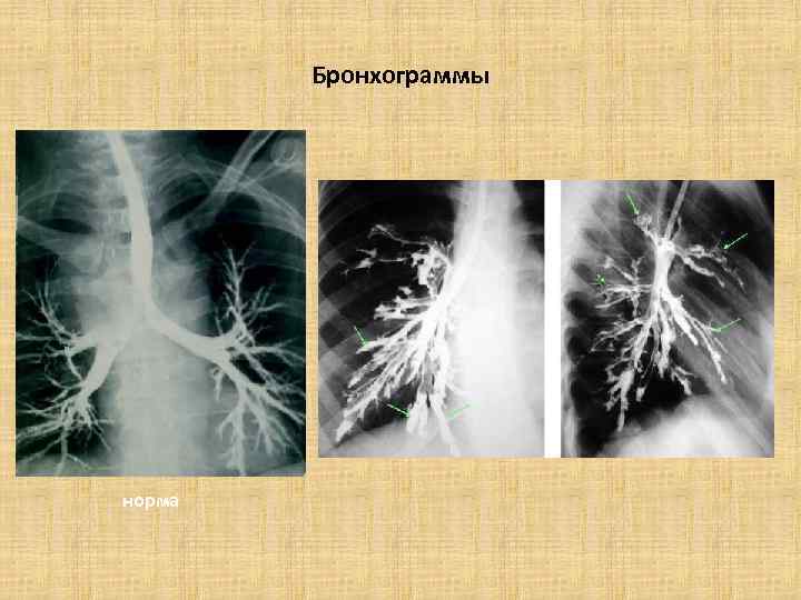 Бронхограммы норма 