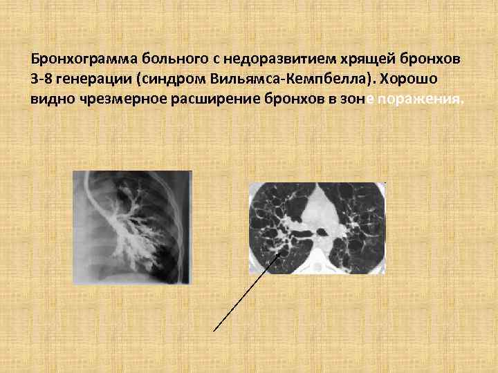 Бронхограмма больного с недоразвитием хрящей бронхов 3 -8 генерации (синдром Вильямса-Кемпбелла). Хорошо видно чрезмерное