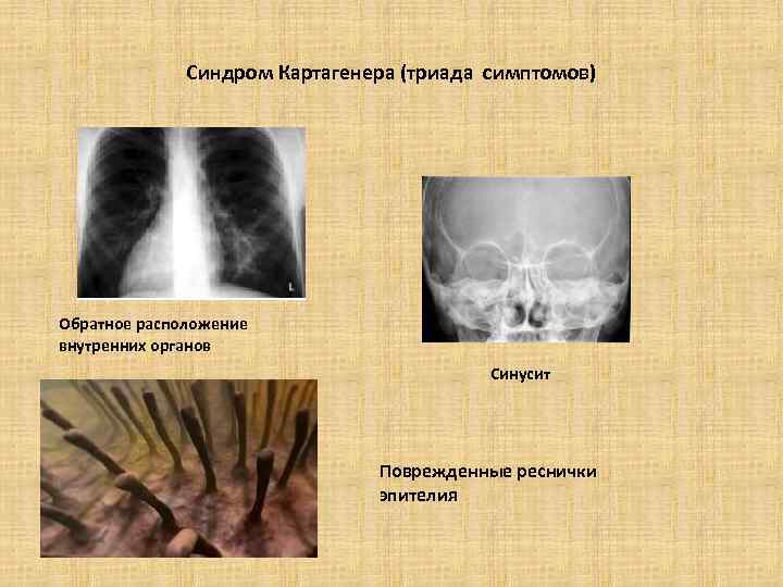 Синдром Картагенера (триада симптомов) Обратное расположение внутренних органов Синусит Поврежденные реснички эпителия 