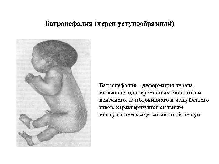 Батроцефалия (череп уступообразный) Батроцефалия – деформация черепа, вызванная одновременным синостозом венечного, ламбдовидного и чешуйчатого