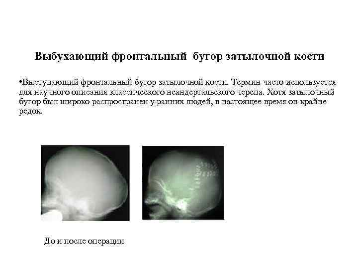 Выбухающий фронтальный бугор затылочной кости • Выступающий фронтальный бугор затылочной кости. Термин часто используется