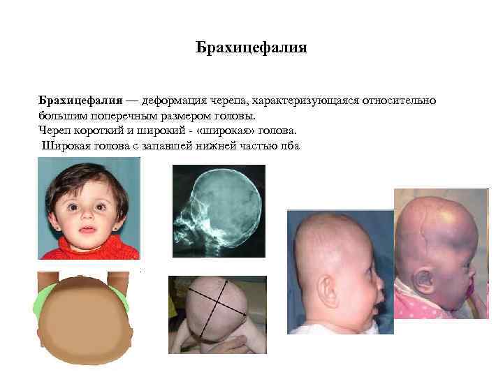 Брахицефалия — деформация черепа, характеризующаяся относительно большим поперечным размером головы. Череп короткий и широкий