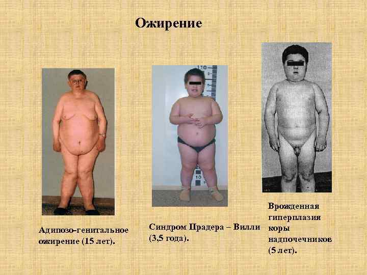 Ожирение Адипозо-генитальное ожирение (15 лет). Врожденная гиперплазия Синдром Прадера – Вилли коры (3, 5
