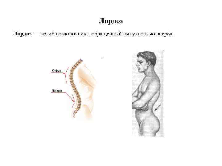 Лордоз это. Лордоз это изгиб позвоночника. Изгибы позвоночника вперед (лордоз)______,. Лордоз — изгиб позвоночника, обращённый выпуклостью вперёд.. Изгиб позвоночника обращенный выпуклостью вперед.