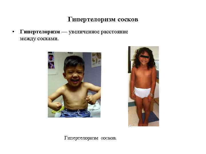 Гипертелоризм сосков • Гипертелоризм — увеличенное расстояние между сосками. Гипертелоризм сосков. 