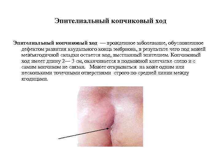 Эпителиальный копчиковый ход — врожденное заболевание, обусловленное дефектом развития каудального конца эмбриона, в результате