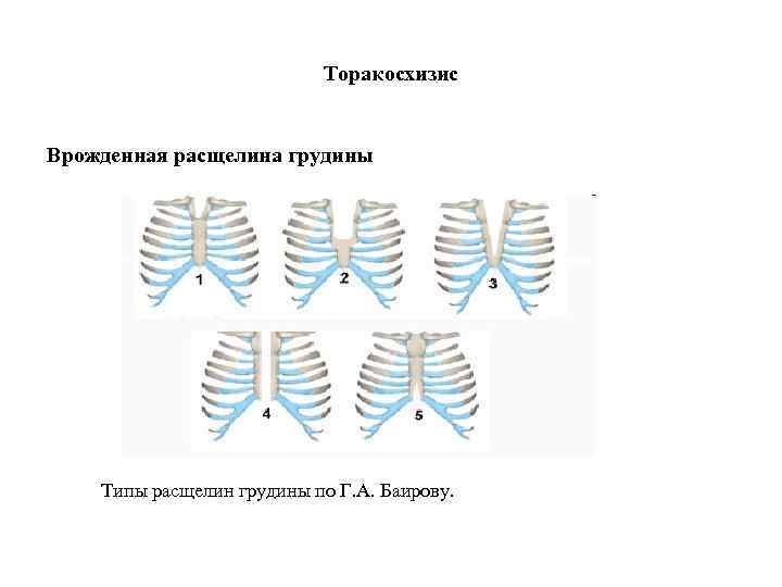 Торакосхизис Врожденная расщелина грудины Типы расщелин грудины по Г. А. Баирову. 