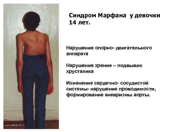 Синдром Марфана у девочки 14 лет. Нарушение опорно- двигательного аппарата Нарушение зрения – подвывих