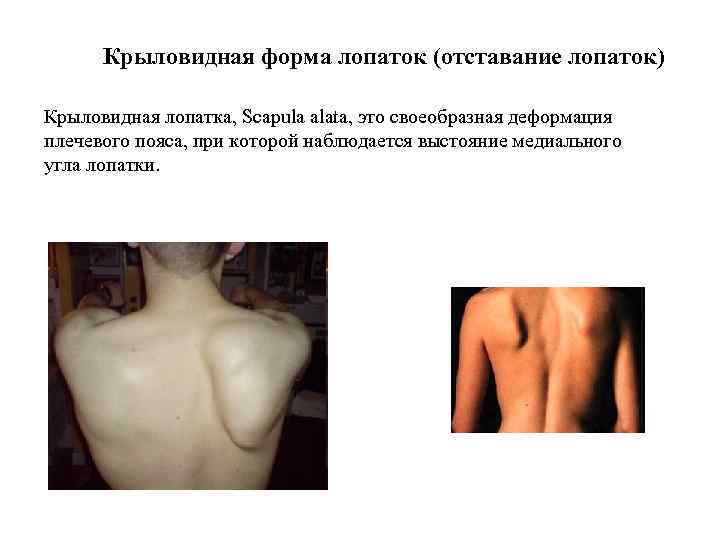 Крыловидная форма лопаток (отставание лопаток) Крыловидная лопатка, Scapula alata, это своеобразная деформация плечевого пояса,