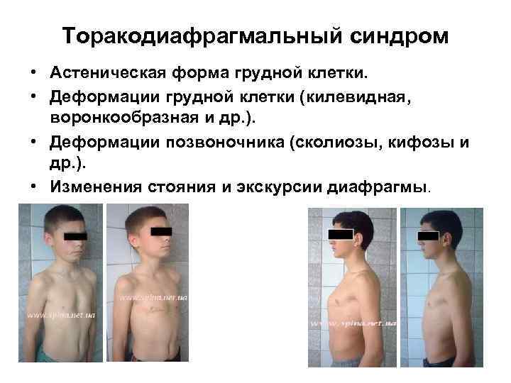 Торакодиафрагмальный синдром • Астеническая форма грудной клетки. • Деформации грудной клетки (килевидная, воронкообразная и