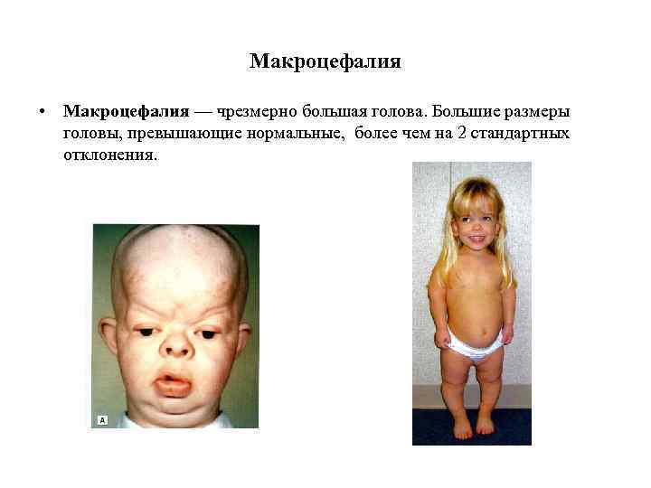 Макроцефалия • Макроцефалия — чрезмерно большая голова. Большие размеры головы, превышающие нормальные, более чем