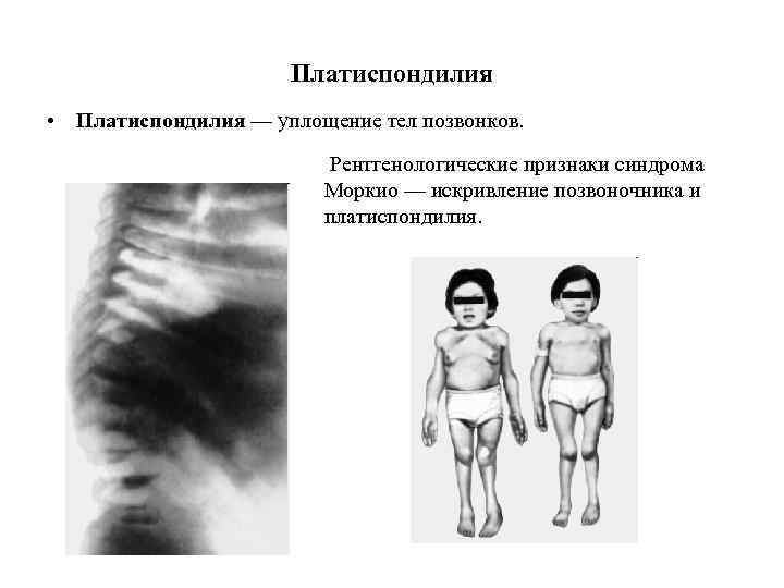 Платиспондилия • Платиспондилия — уплощение тел позвонков. Рентгенологические признаки синдрома Моркио — искривление позвоночника