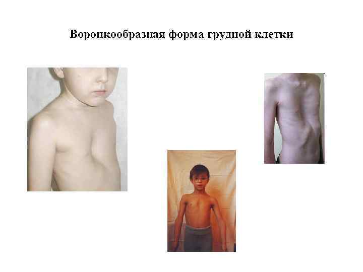 Воронкообразная форма грудной клетки 