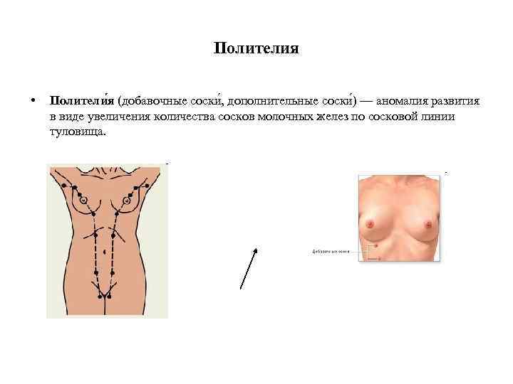 Полителия • Полители я (добавочные соски , дополнительные соски ) — аномалия развития в