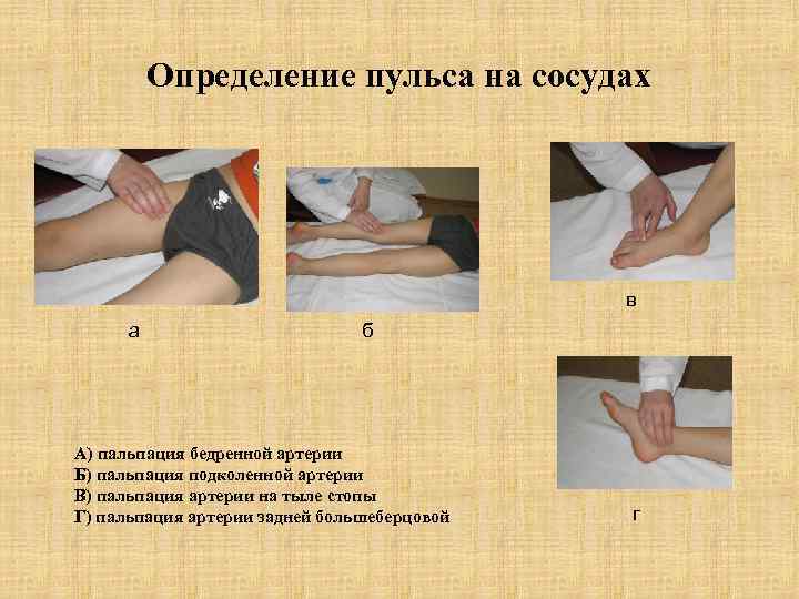 Определение пульса на сосудах в а б А) пальпация бедренной артерии Б) пальпация подколенной