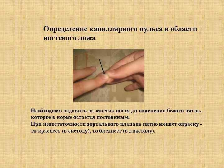Определение капиллярного пульса в области ногтевого ложа Необходимо надавить на кончик ногтя до появления