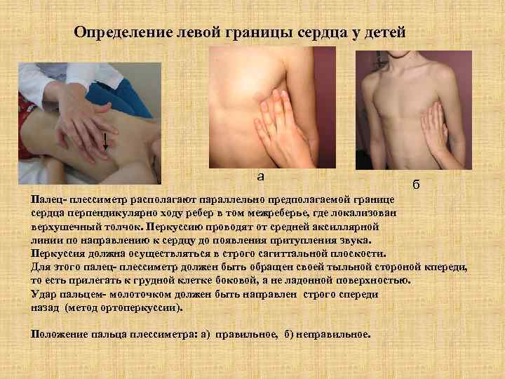 Определение левой границы сердца у детей а б Палец- плессиметр располагают параллельно предполагаемой границе