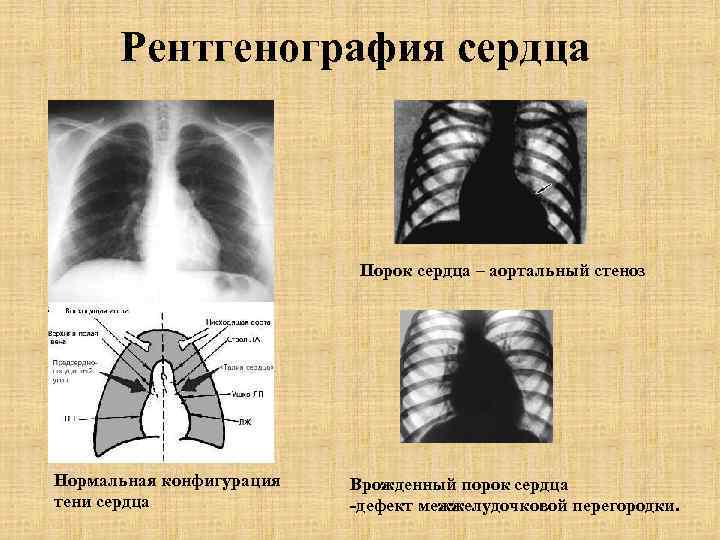 Рентгенография сердца Порок сердца – аортальный стеноз Нормальная конфигурация тени сердца Врожденный порок сердца
