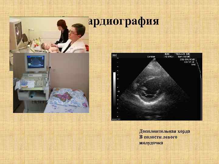 Эхокардиография Дополнительная хорда В полости левого желудочка 