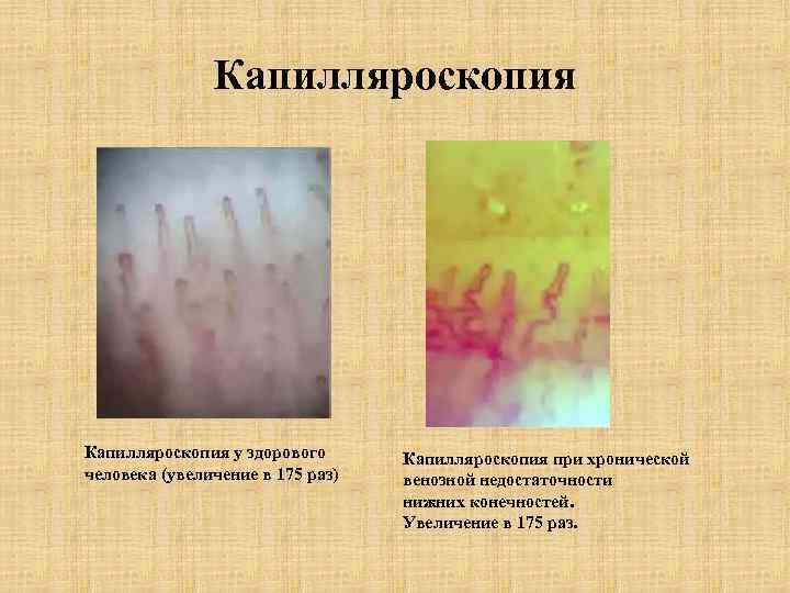 Капилляроскопия у здорового человека (увеличение в 175 раз) Капилляроскопия при хронической венозной недостаточности нижних