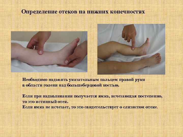 Определение отеков на нижних конечностях Необходимо надавить указательным пальцем правой руки в области голени