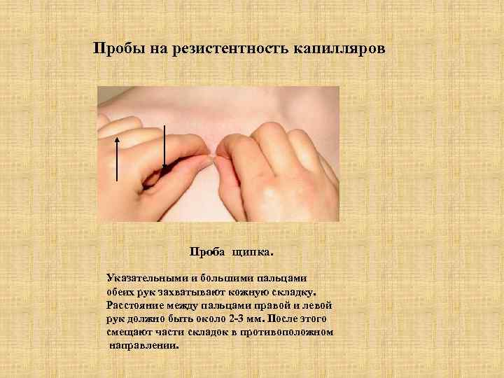 Пробы на резистентность капилляров Проба щипка. Указательными и большими пальцами обеих рук захватывают кожную