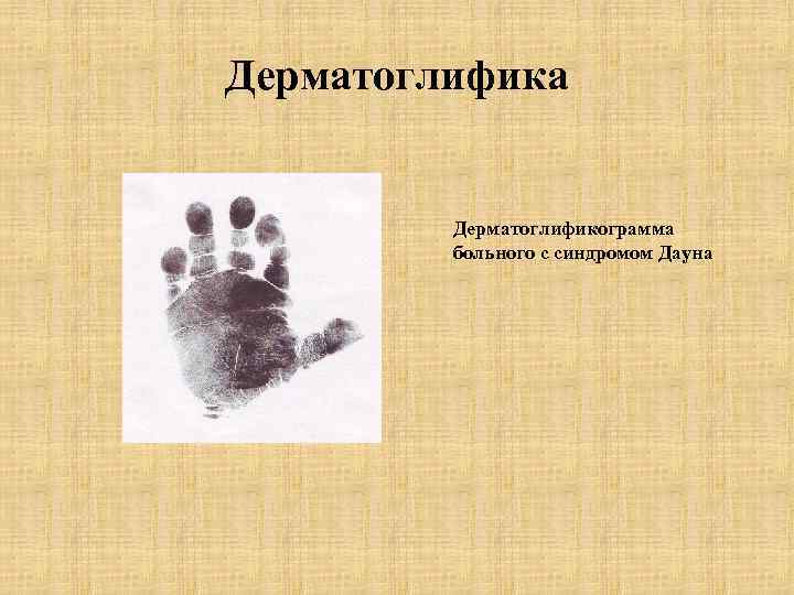 Дерматоглифика Дерматоглификограмма больного с синдромом Дауна 