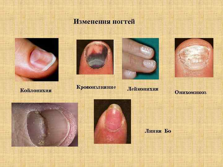 Изменения ногтей Койлонихия Кровоизлияние Лейконихия Линия Бо Онихомикоз 