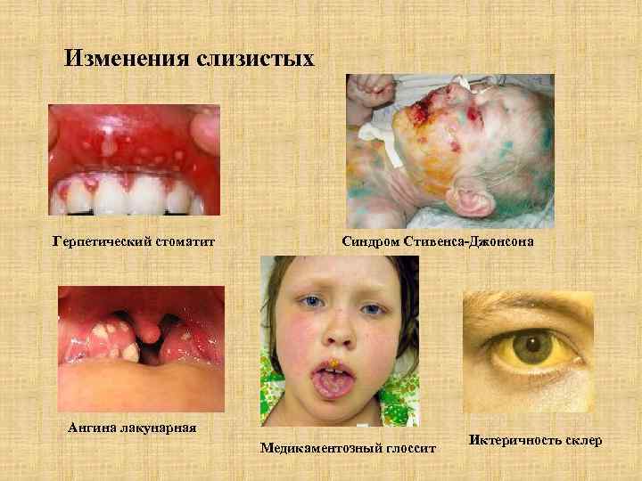 Изменения слизистых Герпетический стоматит Синдром Стивенса-Джонсона Ангина лакунарная Медикаментозный глоссит Иктеричность склер 