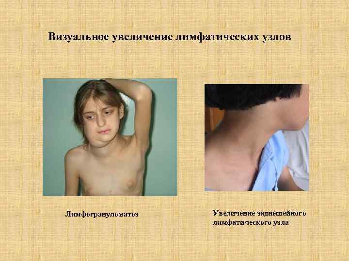 Визуальное увеличение лимфатических узлов Лимфогрануломатоз Увеличение заднешейного лимфатического узла 