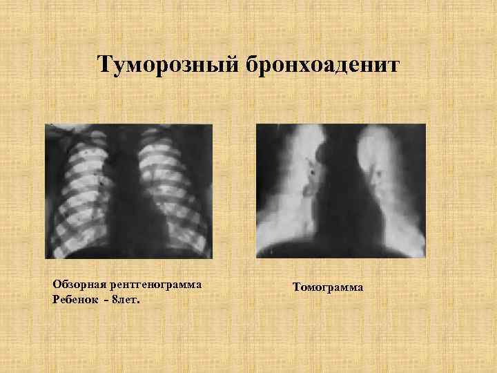 Туморозный бронхоаденит Обзорная рентгенограмма Ребенок - 8 лет. Томограмма 
