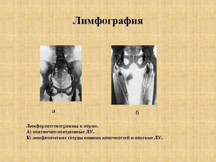 Лимфография а б Лимфорентгенограммы в норме. А) пояснично-повздошные ЛУ. Б) лимфатические сосуды нижних конечностей