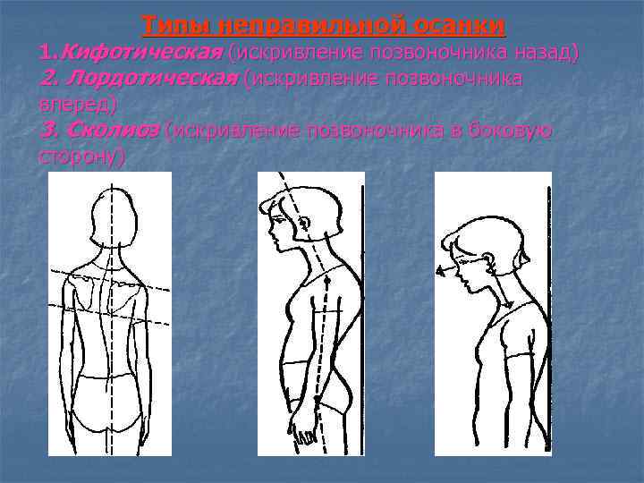 Типы неправильной осанки 1. Кифотическая (искривление позвоночника назад) 2. Лордотическая (искривление позвоночника вперед) 3.