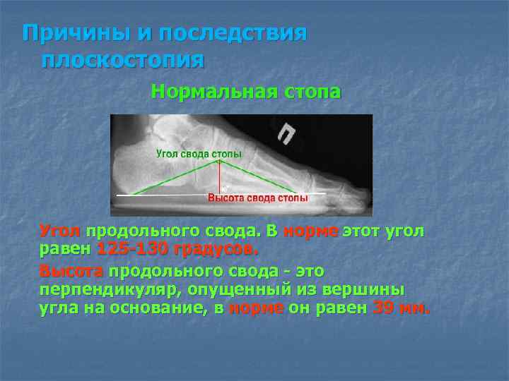 Причины и последствия плоскостопия Нормальная стопа Угол продольного свода. В норме этот угол равен