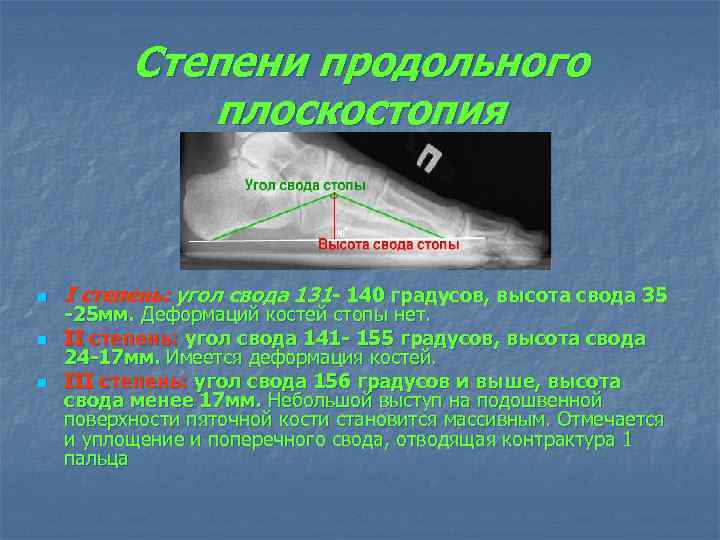 Степени продольного плоскостопия n n n I степень: угол свода 131 - 140 градусов,
