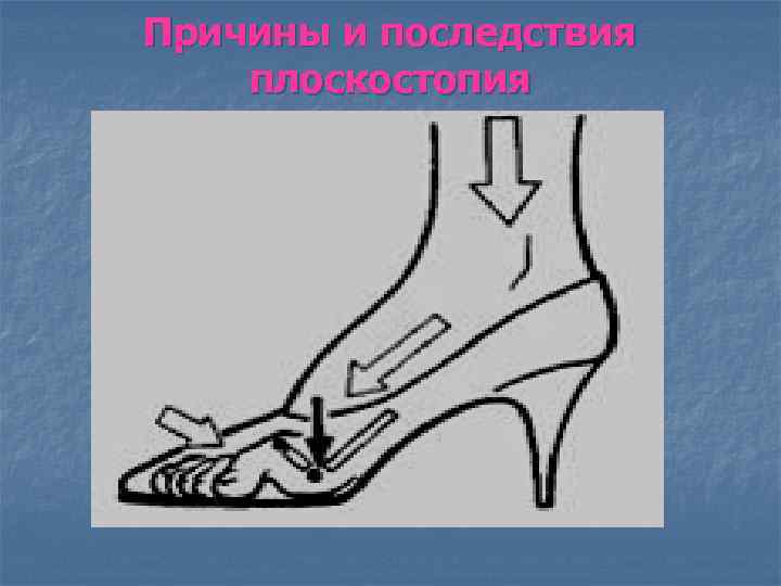 Причины и последствия плоскостопия 
