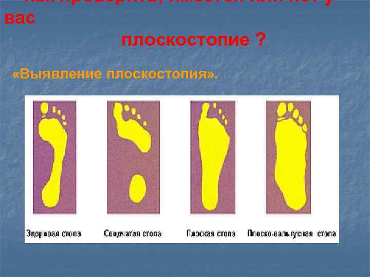Как проверить, имеется или нет у вас плоскостопие ? «Выявление плоскостопия» . 
